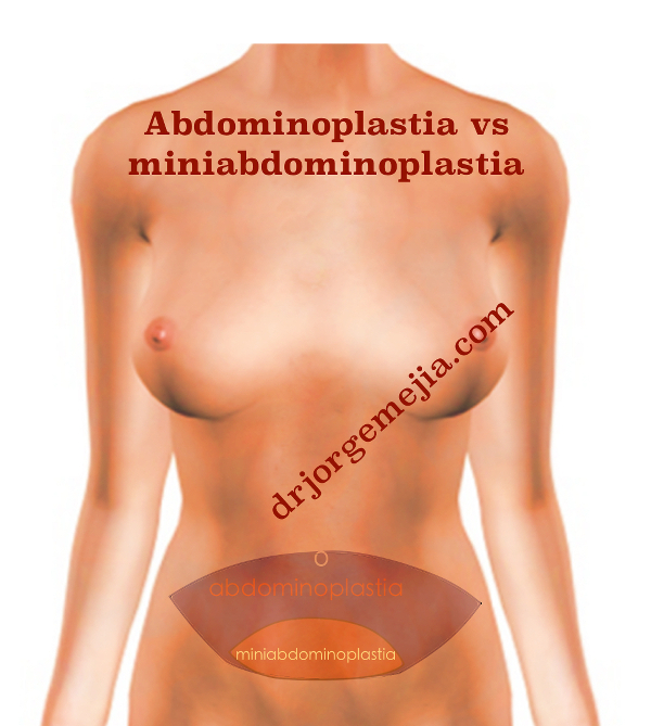 abdominoplastia miniabodiminoplastia w
