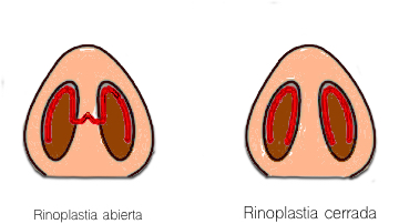 rinoplastia abordajes
