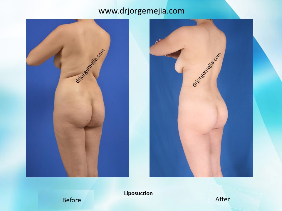 Liposuction – Cirugía Estética Medellín Colombia – Dr. Jorge Mejía