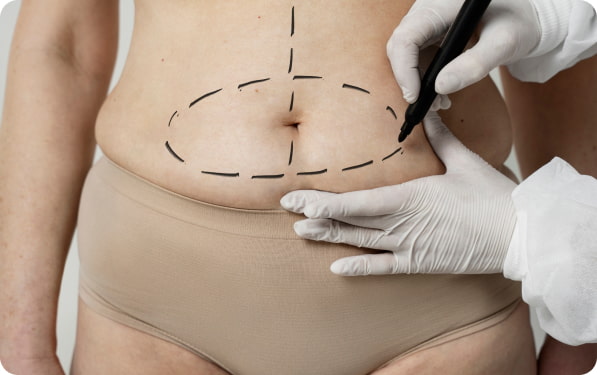 Abdominoplastia – Cirugía Estética Medellín Colombia – Dr. Jorge Mejía